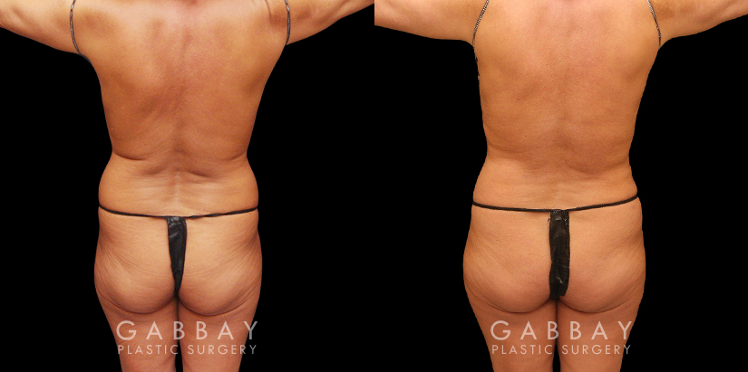 Female African-American patient after liposuction and J plasma treatment to her full abdomen, reducing her bulging belly and to tighten and restore loose skin.
