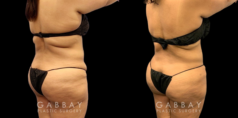 Patient after a traditional liposuction for the stomach (abdominal) area, resulting in a decrease in bulging belly fat (rolls) with a notable restoration of her natural body shape.