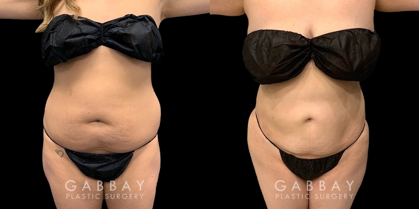 Female patient in her middle years after an abdominal liposuction surgery. The slimmed portions of the stomach area contribute to a more shapely appearance overall.