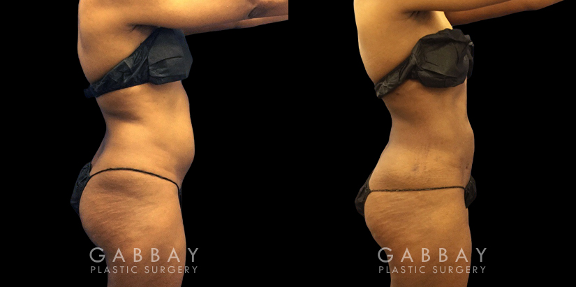 Female patient with notable contouring of the abdominal area after liposuction, resulting in a more youthful figure free from any bulging fat deposits.