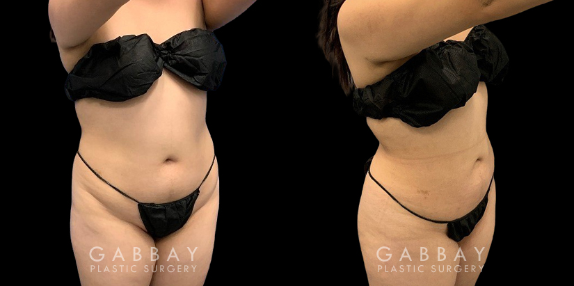 Patient who wanted mild liposuction to reduce tummy bulge from stubborn fat, with subtle results that lend a more balanced figure. Note how the puncture sites healed well for little to no visibility.