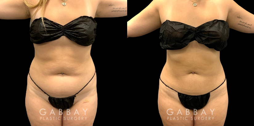 Before and after liposuction surgery for reducing mild bulging pockets of fat on the upper and lower abdomen, restoring a tighter stomach appearance without and bulging fat.