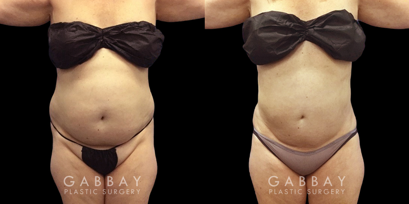 Patient had a significant bulge of stubborn belly fat across the entire abdomen. Liposuction was used to reduce the pocket, encouraging patient to jump start lifestyle enhancements to further boost her figure.