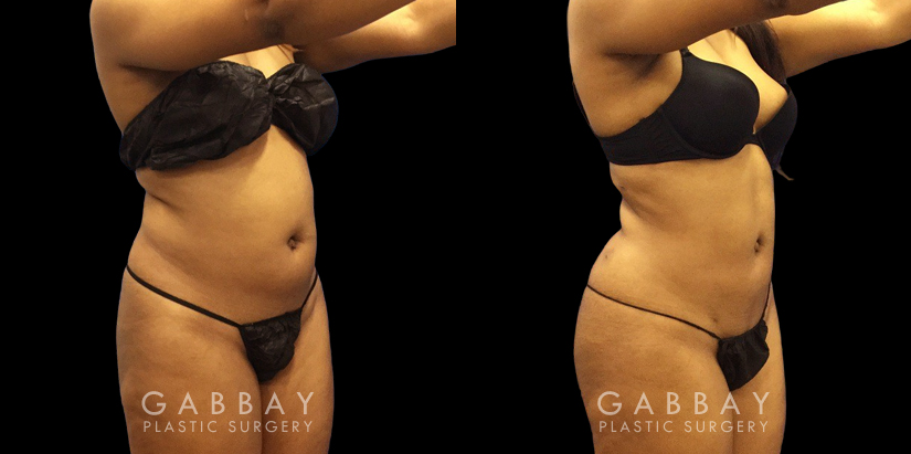 Younger female patient showcasing her results after belly fat removal via liposuction surgery. Note the reduction of ‘love handles’ and a flatter stomach for a defined lower torso aesthetic.