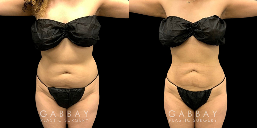 Patient with mild liposuction for the abdomen to help reduce some of the stubborn pockets of fat while also slimming the waist for a renewed youthful shape.