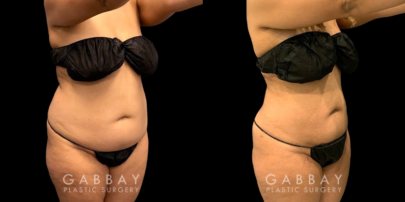 Patient who wanted to address a more significant amount of fat over the belly area. Using targeted liposuction, Dr. Gabbay removed the fat while keeping a balanced shape and aesthetic to the abdominal area.