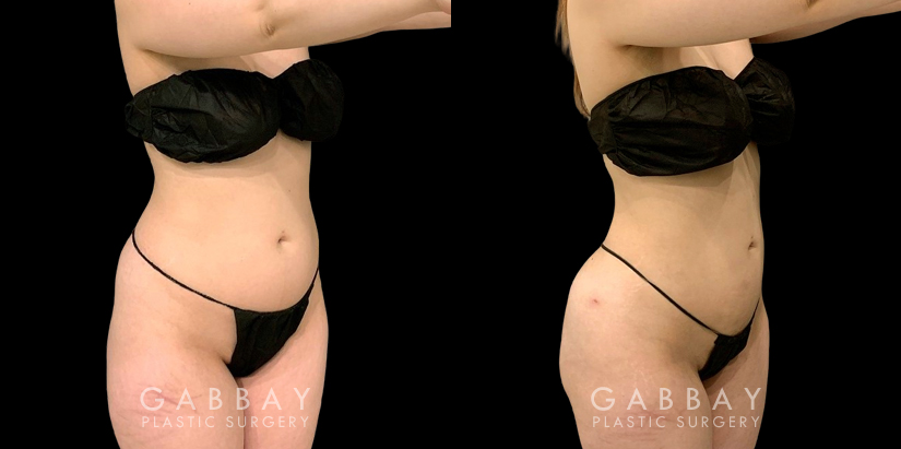 Liposuction results for fat removal along the tailbone, waist, and abdomen, resulting in emphasis of natural curves for a youthful, rejuvenating aesthetic to become visible.