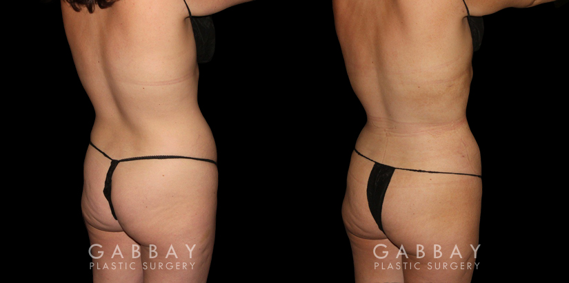 Patient 46 Back View Mastopexy and Liposuction Gabbay Plastic Surgery
