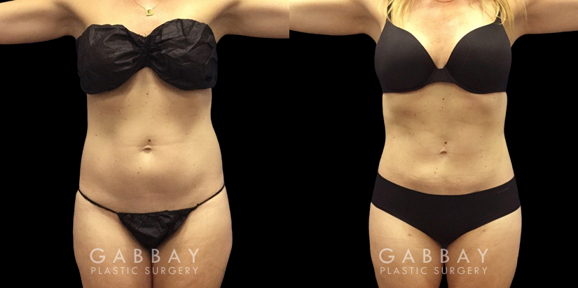 Front and side views of before and after liposuction for female patient. The surgery resulted in a flatter stomach with no notable bulging pockets of fat.