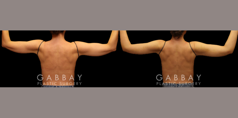 Patient 01 Back View Liposuction to Arms with J Plasma Gabbay Plastic Surgery