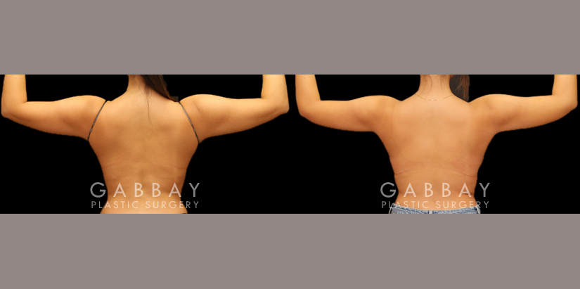 Patient 06 Back View Arm Liposuction with J Plasma Gabbay Plastic Surgery