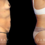 Patient before and after plastic surgery combination procedure involving breast augmentation (silicone implants), tummy tuck, and liposuction of the flanks. The combined results show a slimmer, more youthful profile with an enhanced feminine shape.