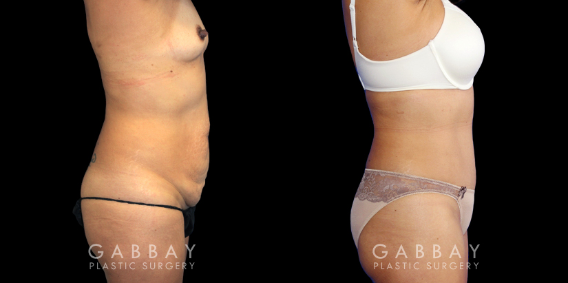 Patient 06 Right Side View Breast Augmentation Silicone, Abdominoplasty, Flank Liposuction Gabbay Plastic Surgery
