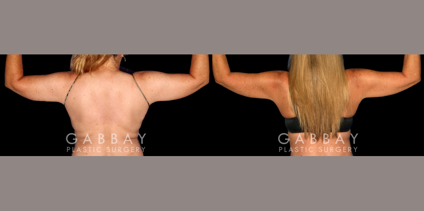 Patient 08 Back View Liposuction to Abdomen, Waist, Tailbone & Arms Gabbay Plastic Surgery