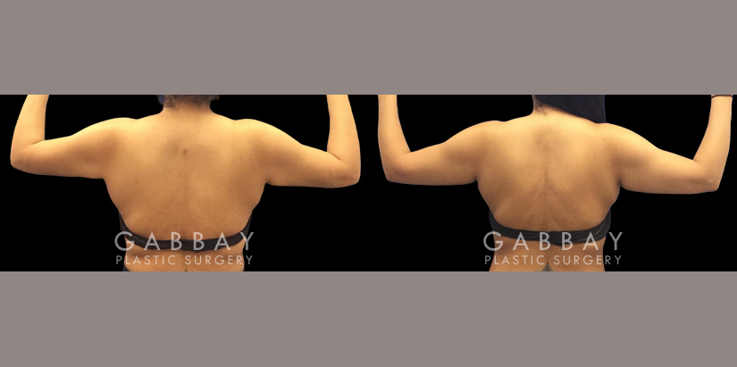 Patient 12 Back View Lipo Arms Gabbay Plastic Surgery