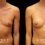 This is an extremely athletic woman who wanted a softer look for her torso. She had silicone breast augmentation using Allergan Natrelle soft touch moderate profile implants placed through a lower breast/inframammary incision and under her muscle in a dual plane position.. Her implants were 255 cc.