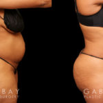 Tummy tuck patient before and after her procedure. Photos demonstrate the lack of visible scarring, a flattened abdomen, and removal of stretch marks through precise tightening techniques.