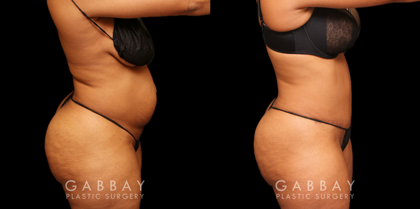 Tummy tuck patient before and after her procedure. Photos demonstrate the lack of visible scarring, a flattened abdomen, and removal of stretch marks through precise tightening techniques.