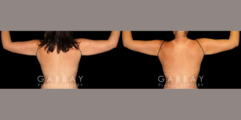 Patient 13 Back View Mastopexy and Liposuction Gabbay Plastic Surgery