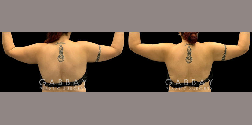 Patient 15 Back View Lipo Arms Gabbay Plastic Surgery