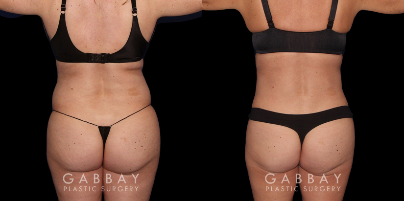 Patient 04 Back View Liposuction to Abdomen, Waist, Tailbone & Arms Gabbay Plastic Surgery