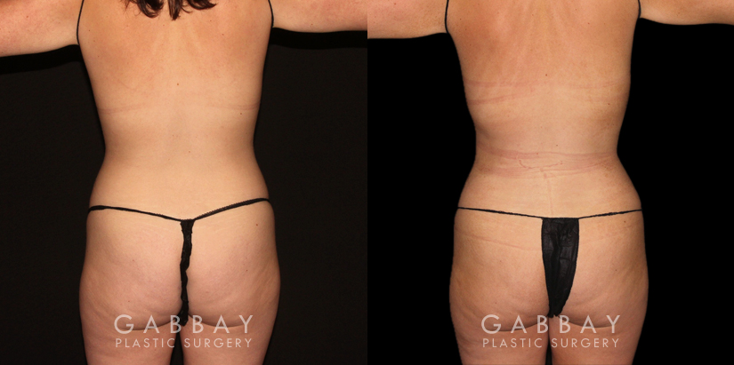 Patient 07 Back View Mastopexy and Liposuction Gabbay Plastic Surgery