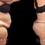 Tummy tuck patient results after abdominal tightening and liposuction to remove loose skin and stubborn pockets of fat. Note the complete tightening of back rolls, resulting in a smoother profile.