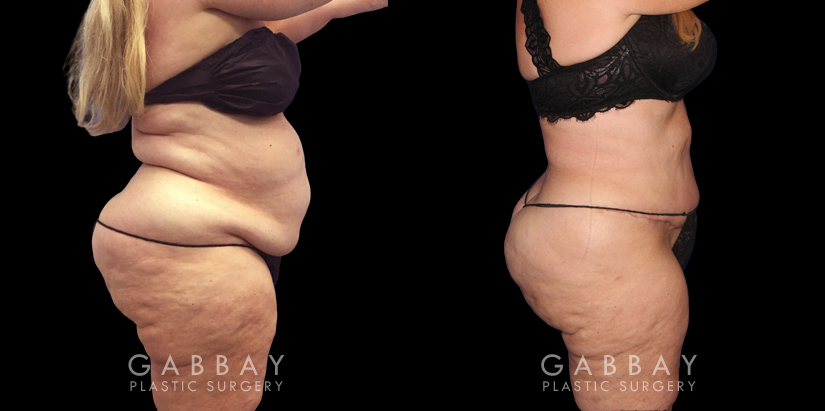 Tummy tuck patient results after abdominal tightening and liposuction to remove loose skin and stubborn pockets of fat. Note the complete tightening of back rolls, resulting in a smoother profile.