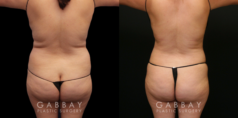 Patient 08 Back View Lipo to Full Abdomen, Bra Roll and Pubis Gabbay Plastic Surgery