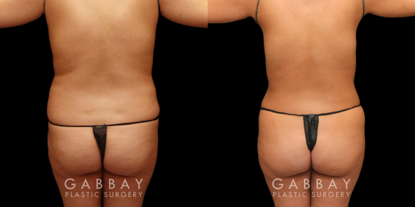 Patient 10 Back View Liposuction Waist, Abdomen, Tail Bone, Back Bra Roll Gabbay Plastic Surgery