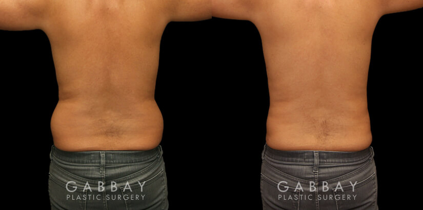 Patient 11 Back View Liposuction and J Plasma to Full Abdomen Gabbay Plastic Surgery