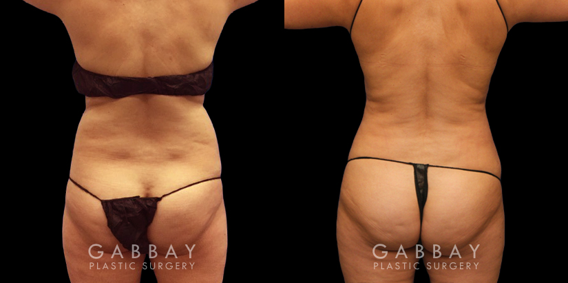 Patient 18 Back View Liposuction Back Bra Roll Gabbay Plastic Surgery
