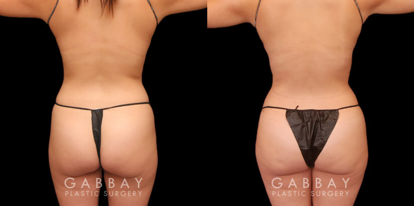 Patient 12 Back View Lipo to Abdomen and Waist and Fat Transfer to Buttock Gabbay Plastic Surgery