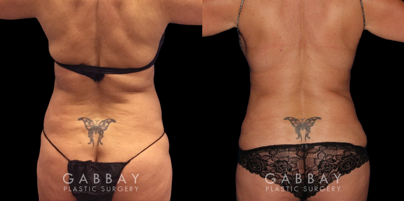 Patient 13 Back View Abdominoplasty Gabbay Plastic Surgery