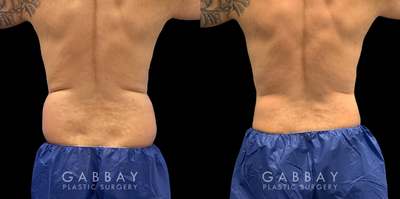 Patient 14 Back View Waist Lipo Gabbay Plastic Surgery