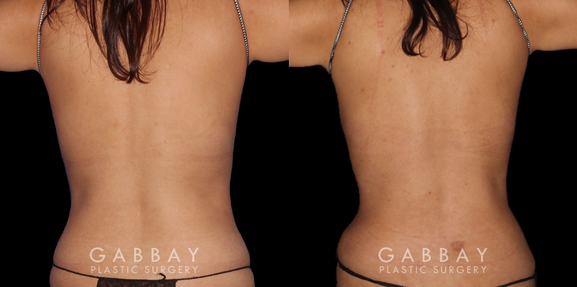 Patient 20 Back View Abdominoplasty, Lipo to Waist and Arms Gabbay Plastic Surgery