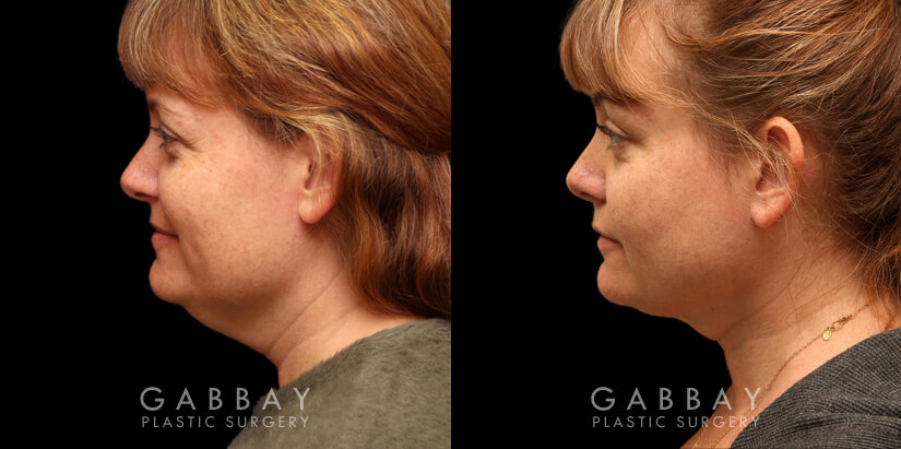 Lipo to chin and jaw