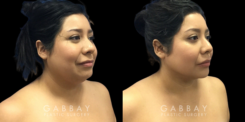 Patient 08 3/4th Right Side View BLipo Neck Gabbay Plastic Surgery