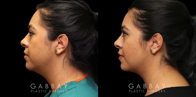 Patient 06 Left Side View Buccal Fat Removal with Lipo to Chin Gabbay Plastic Surgery