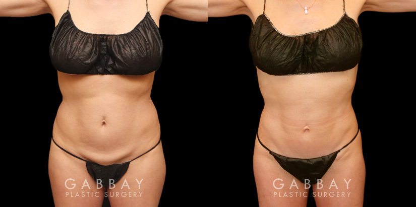 Before and after photos for a mini tummy tuck patient, with combined liposuction around the waist. The combined procedure resulted in notable flattening of the stomach with all fat rolls smoothed out.