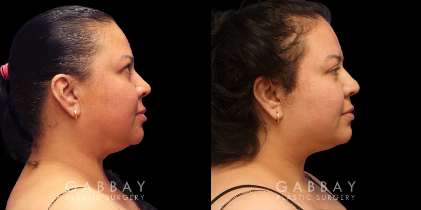 Chin/Neck Liposuction