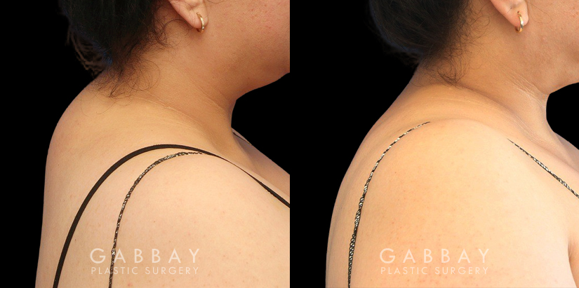 Patient 03 Right Side View Liposuction BBR and Arms with J-Plasma Gabbay Plastic Surgery