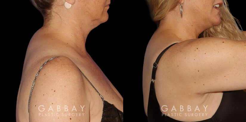 Patient 01 Right Side View Liposuction to Abdomen, Waist, Tailbone & Arms Gabbay Plastic Surgery