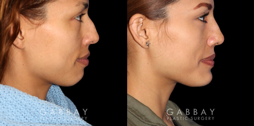 Patient 01 Right Side View Chin implant, Rhinoplasty, BAM Gabbay Plastic Surgery