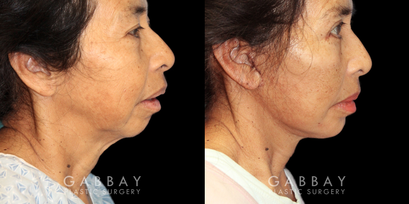 Patient 02 Right Side View Chin Implant, facelift, Bleph Gabbay Plastic Surgery