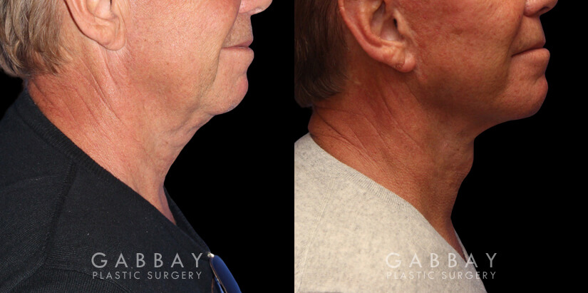 Patient 01 Right Side View facelift, full neck lift, upper blepharoplasty Gabbay Plastic Surgery