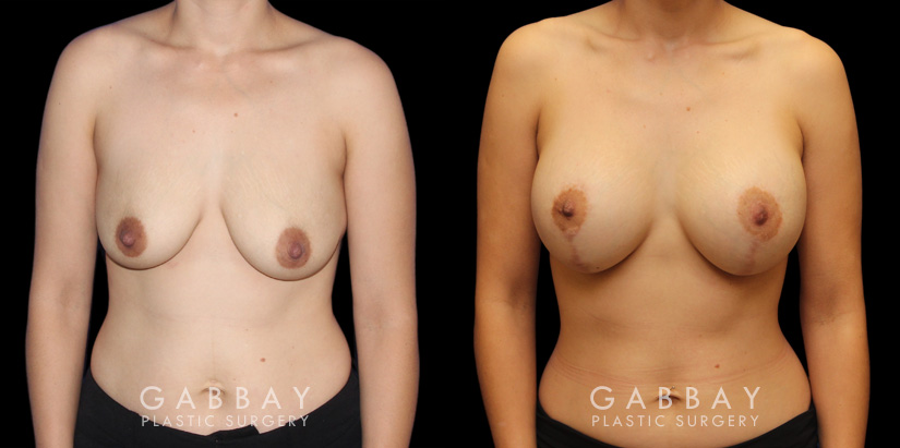 Scar revision to breasts results with additional breast augmentation and lift combination. Patient improved breast size and position with mild scarring only.