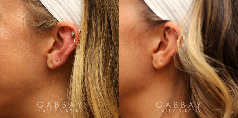 Patient 04 Left Side View Earlobe Repair Gabbay Plastic Surgery