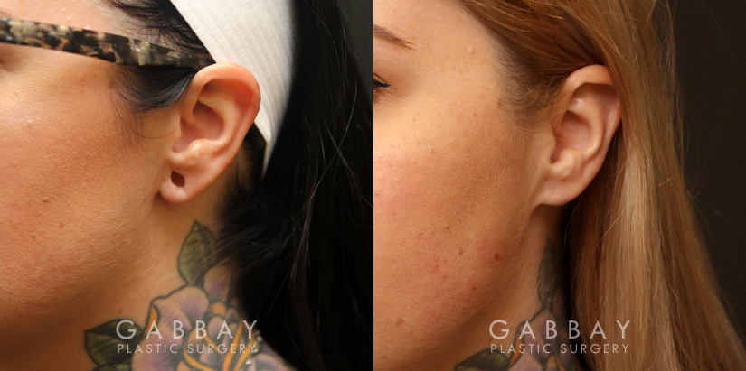 Patient 02 3/4th Left Side View Earlobe Repair Gabbay Plastic Surgery