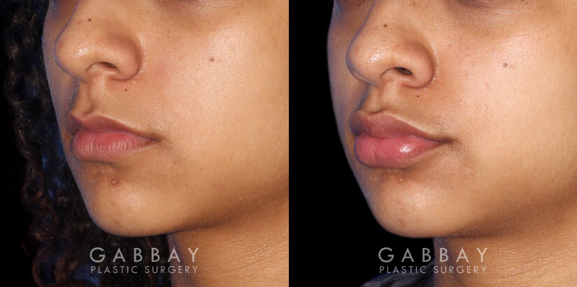 Patient 01 3/4th Left Side View Lip Augmentation Gabbay Plastic Surgery